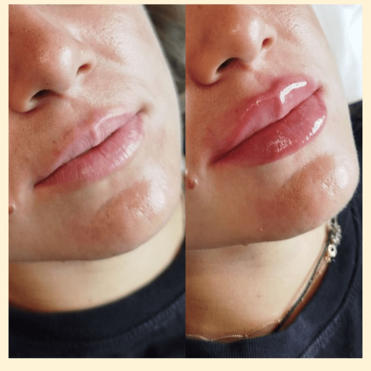 Фото до и после увеличения губ 1
