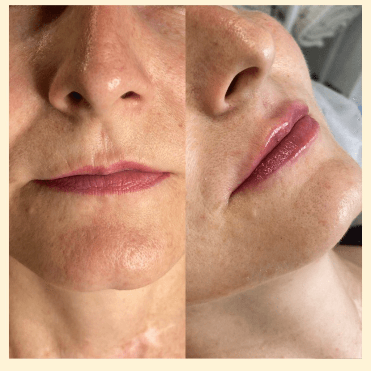 Фото до и после увеличения губ 10