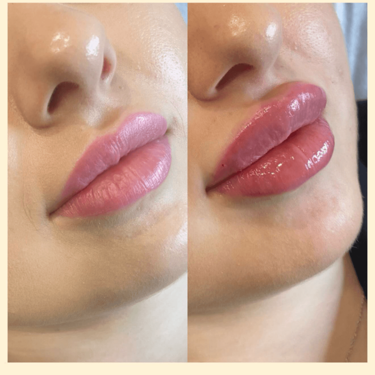 Фото до и после увеличения губ 4