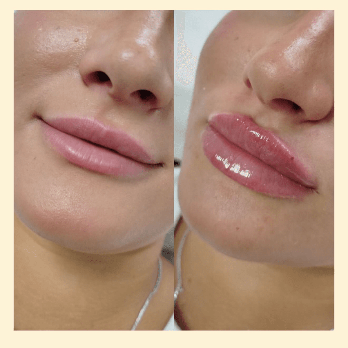 Фото до и после увеличения губ 6